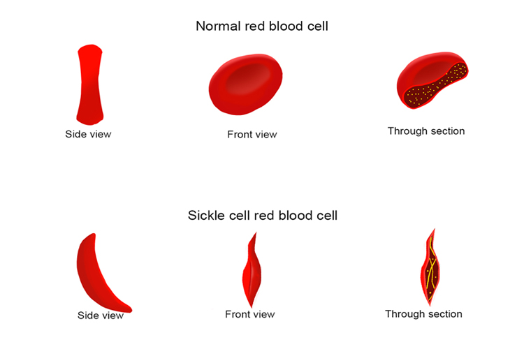 The disease sickle cell is caused by a mutation in the base sequence